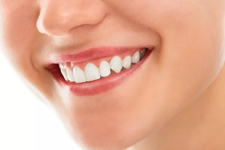 Why Teeth Whitening is important. Benefits of teeth whitening.