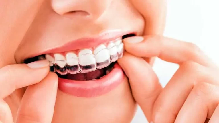 What is Clear Dental Aligner, First Priority Medical Center